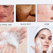 Lucacci For Accne Spot Cleansing Lotion 50Ml (Pack of 2)